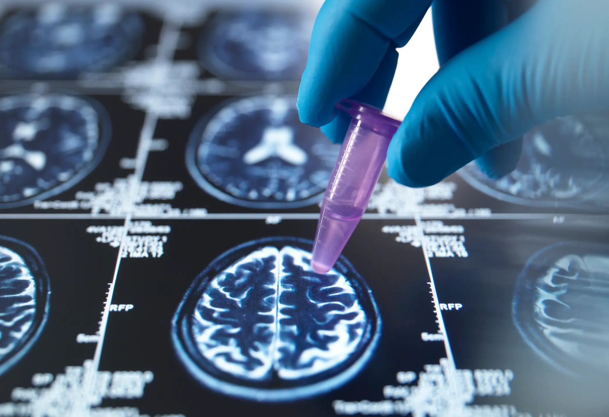 Alzheimer's can affect those under 65 (Getty Images)
