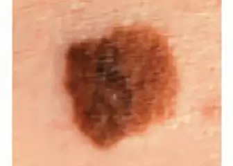 D is for Diameter or Dark (Skin Cancer Foundation) 