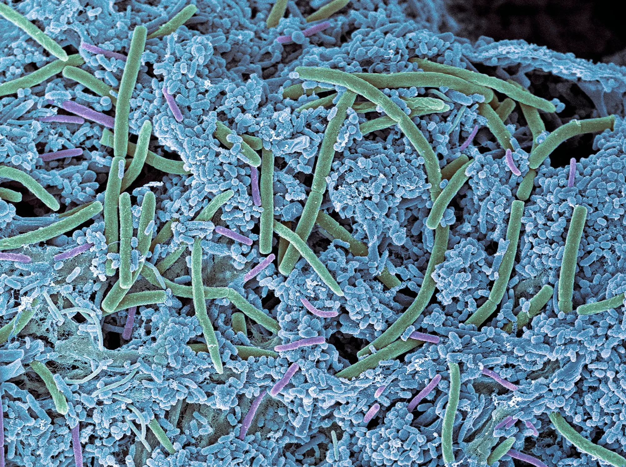 Cavities are causes by S mutans bacteria, which builds up in dental plaque (Getty Stock Images)