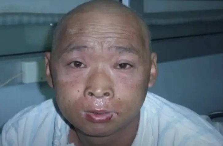 Ouchi as the radiation began to impact his body (YouTube/Peaked Interest)