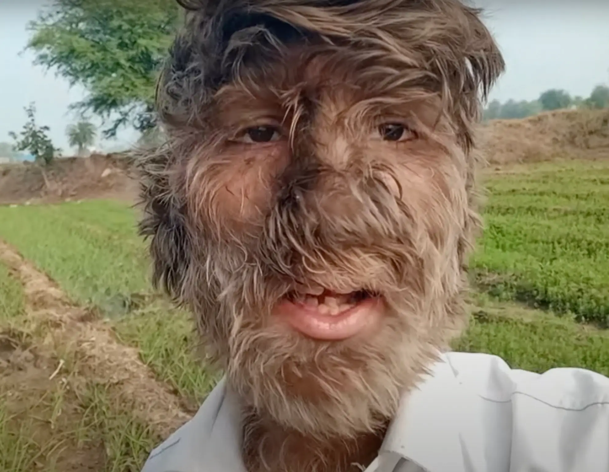 Lalit Patidar has a condition known as 'werewolf syndrome'.