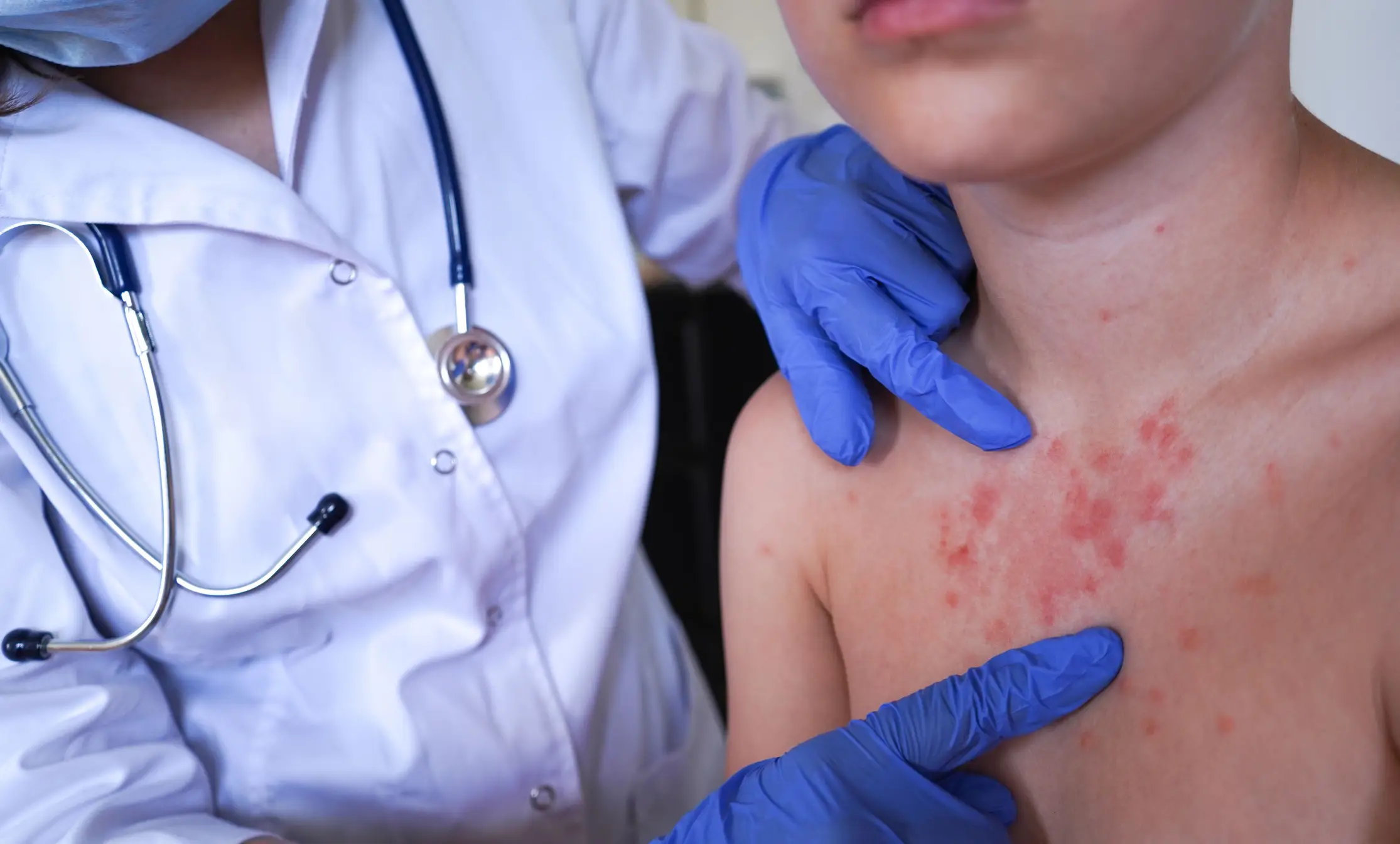 Scabies can leave an intensely itchy rash (Getty Stock)