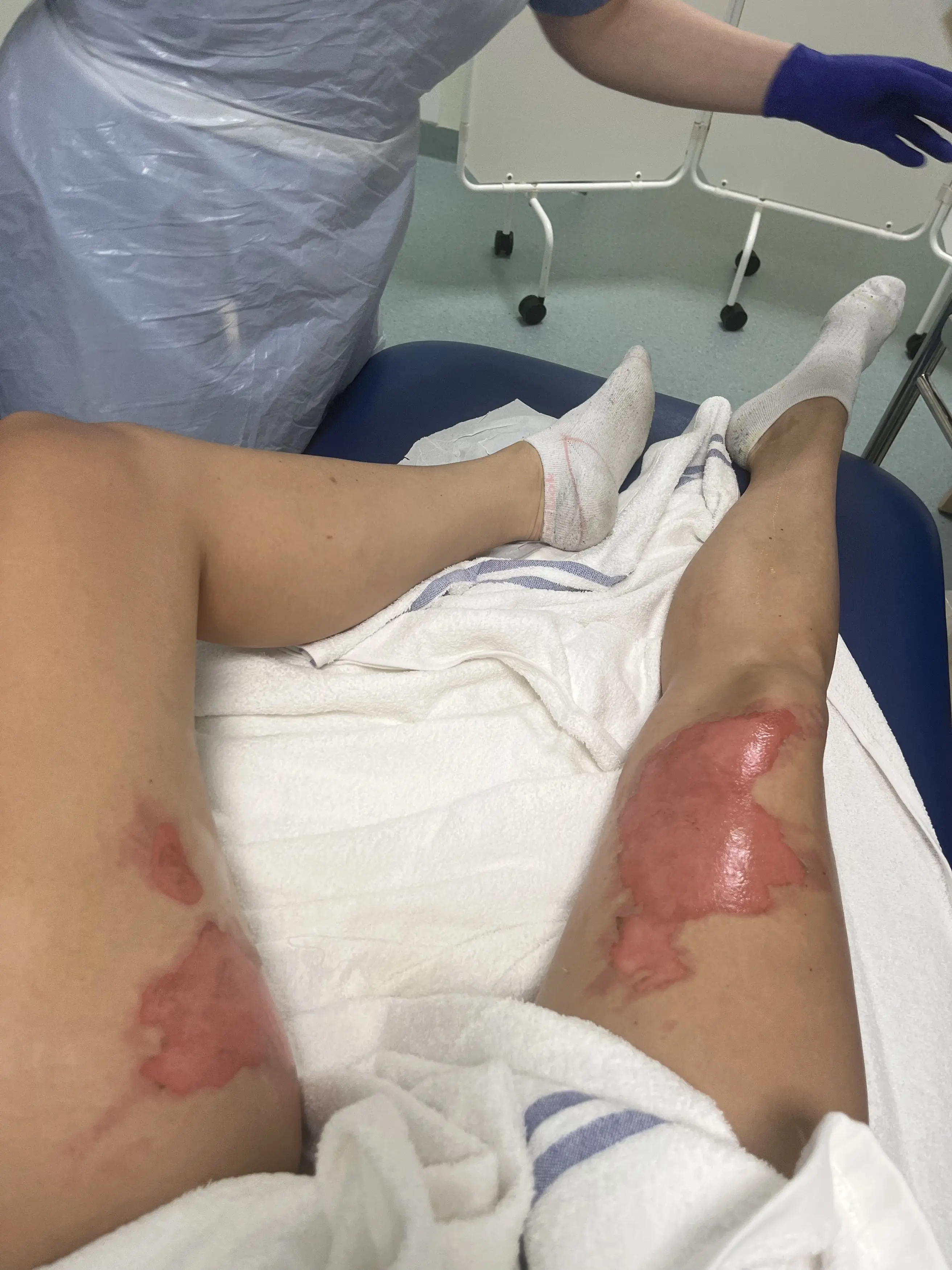 She was left screaming in pain after the hot liquid seeped over her body (Kennedy News and Media)