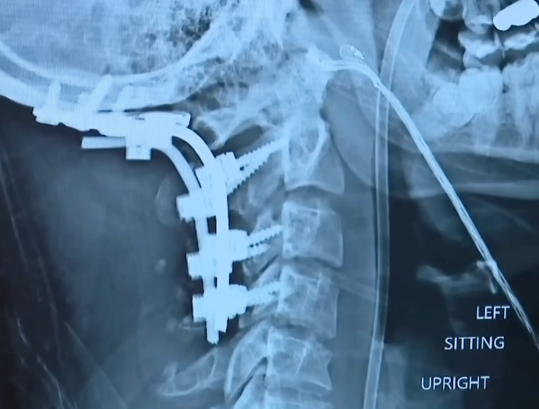 His spine and skull completely separated in the accident (WBNS 10TV)