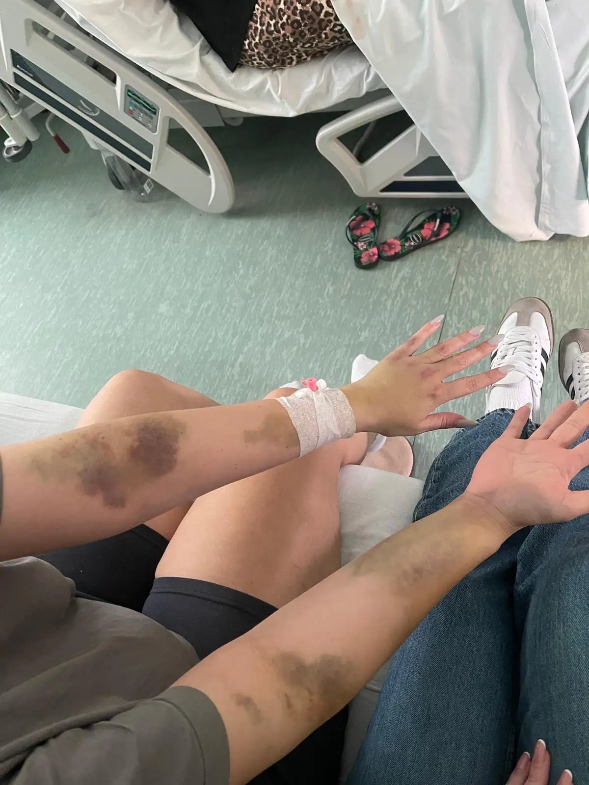 She also suffered severe bruising at the hospital (PA)