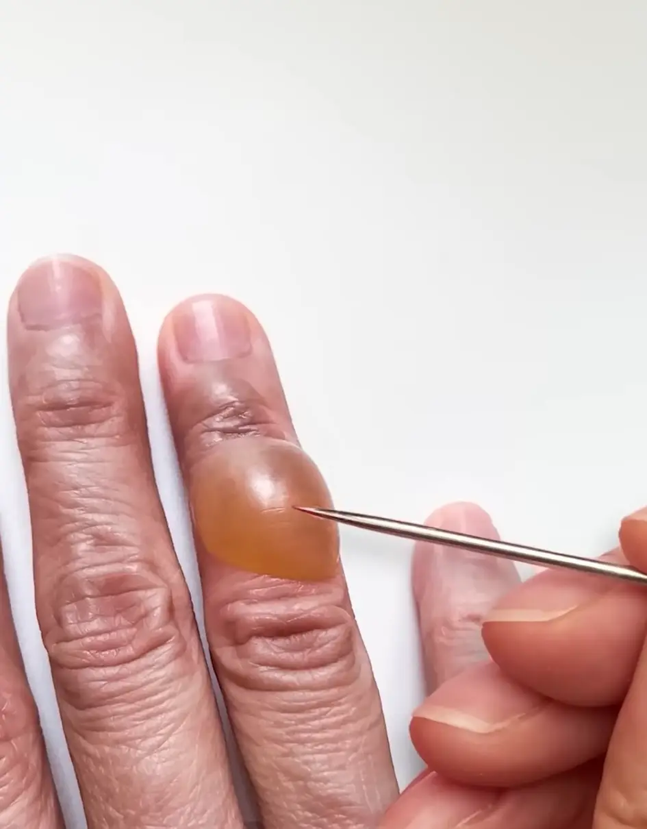 Zack explained why you shouldn't pop blisters, no matter how tempting it may be (YouTube/Zack D Films)