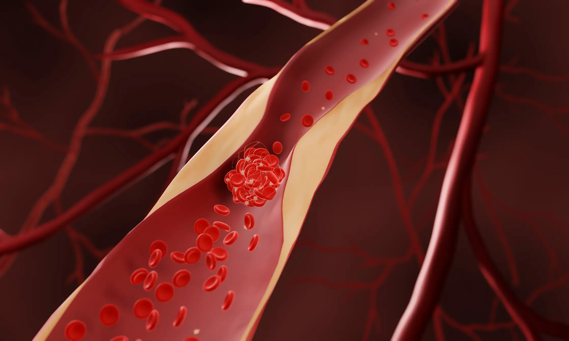 Atherosclerosis is the narrowing of the arteries (ARTUR PLAWGO/SCIENCE PHOTO LIBRARY/Getty stock images)