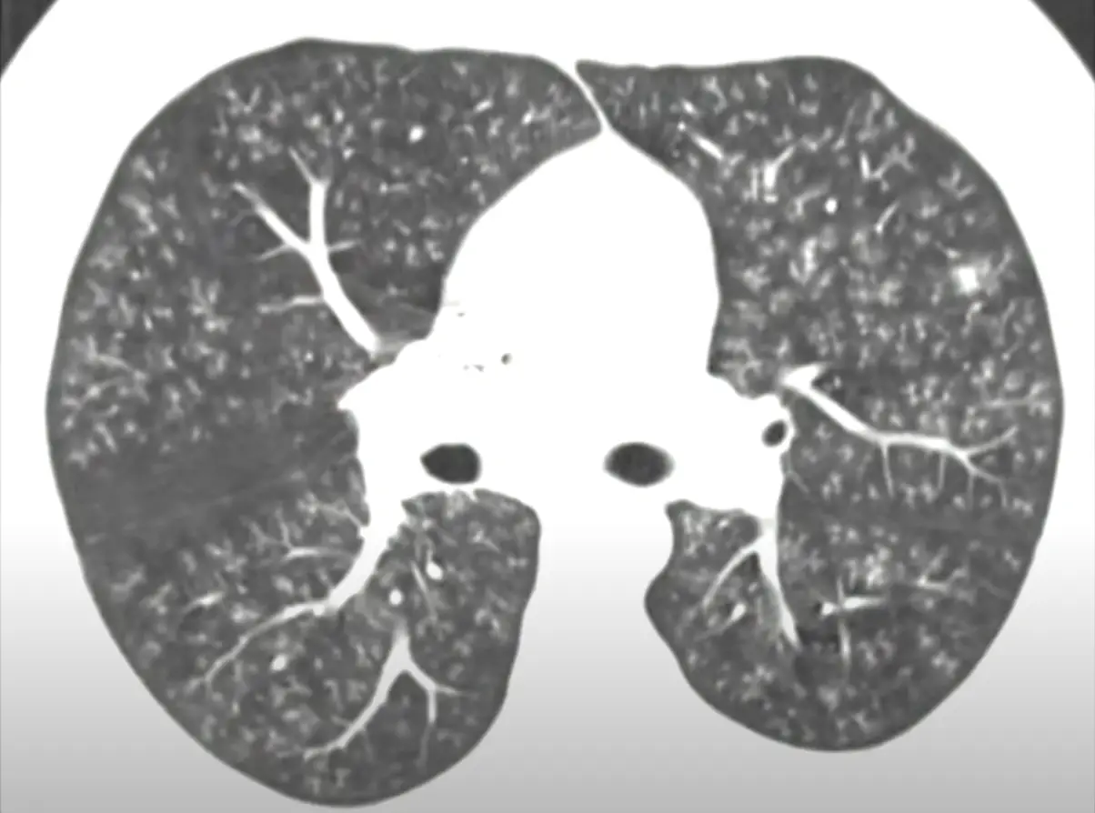 Popcorn lung seen on an x-ray (CBS)