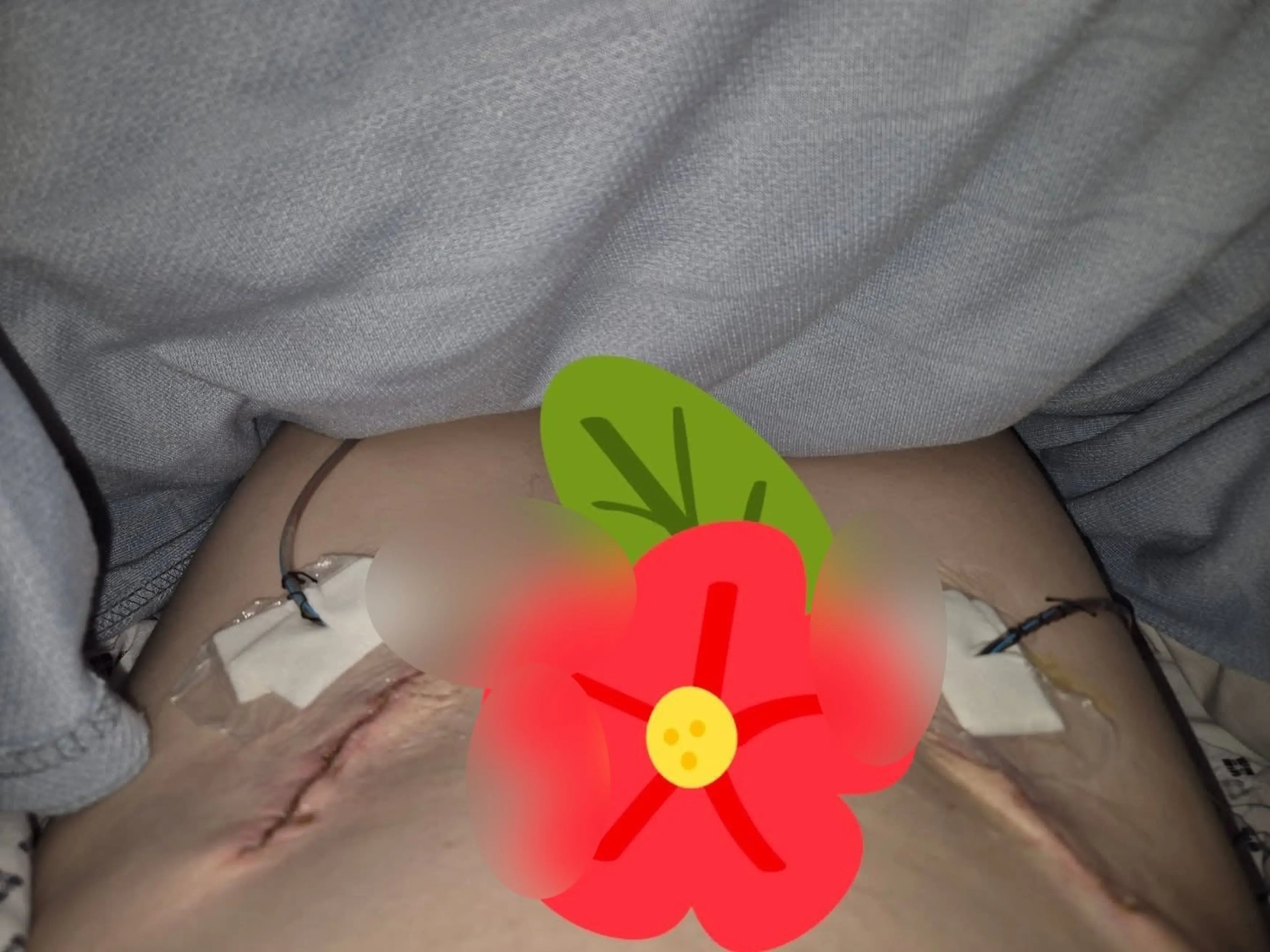 Laura had parts of her labia removed as well as lymph nodes from her groin. (Kennedy News and Media)