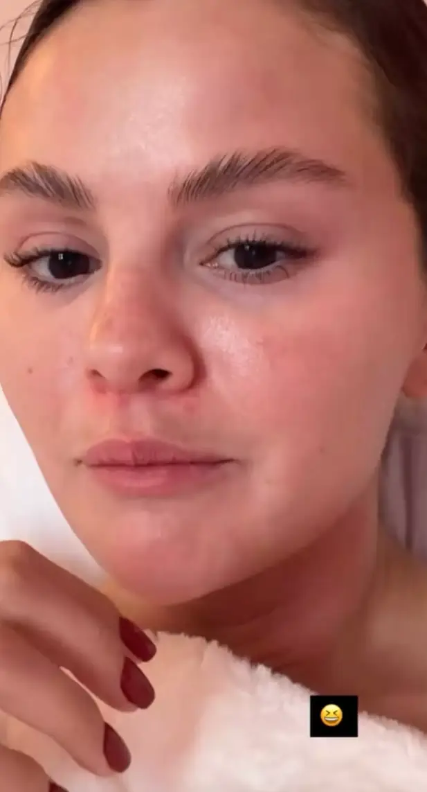 Gomez, 33, explained that her alleged moustache is actually the result of a skin condition (Instagram/@selenagomez)