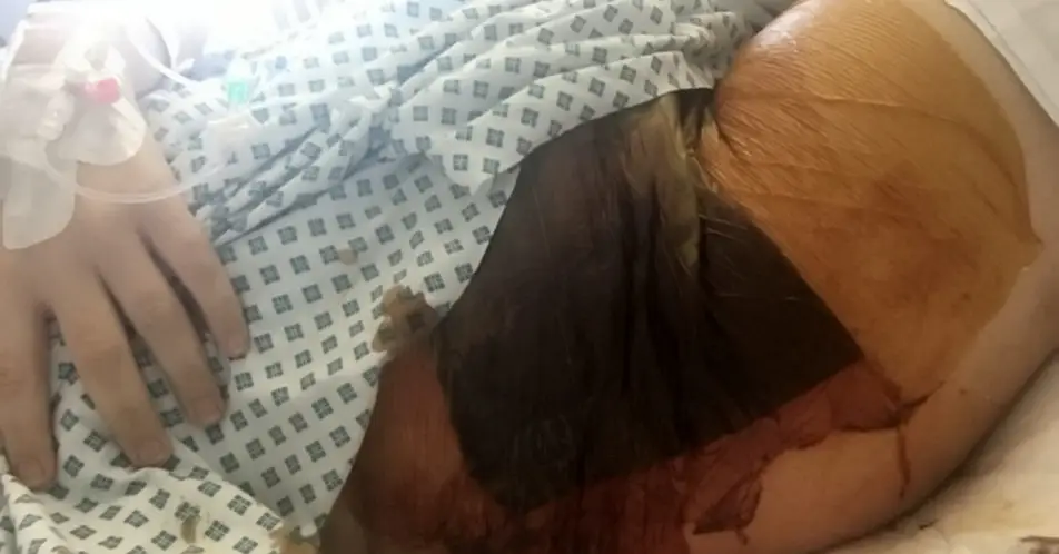 Amy was left with a gaping hole in her tummy.