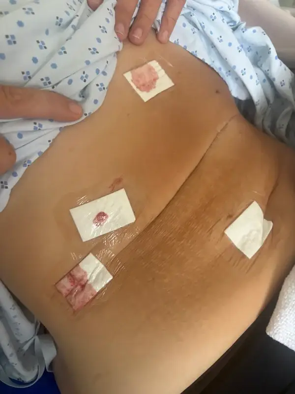 Leasha needed her gallbladder removed while losing eight stone on Mounjaro (SWNS)