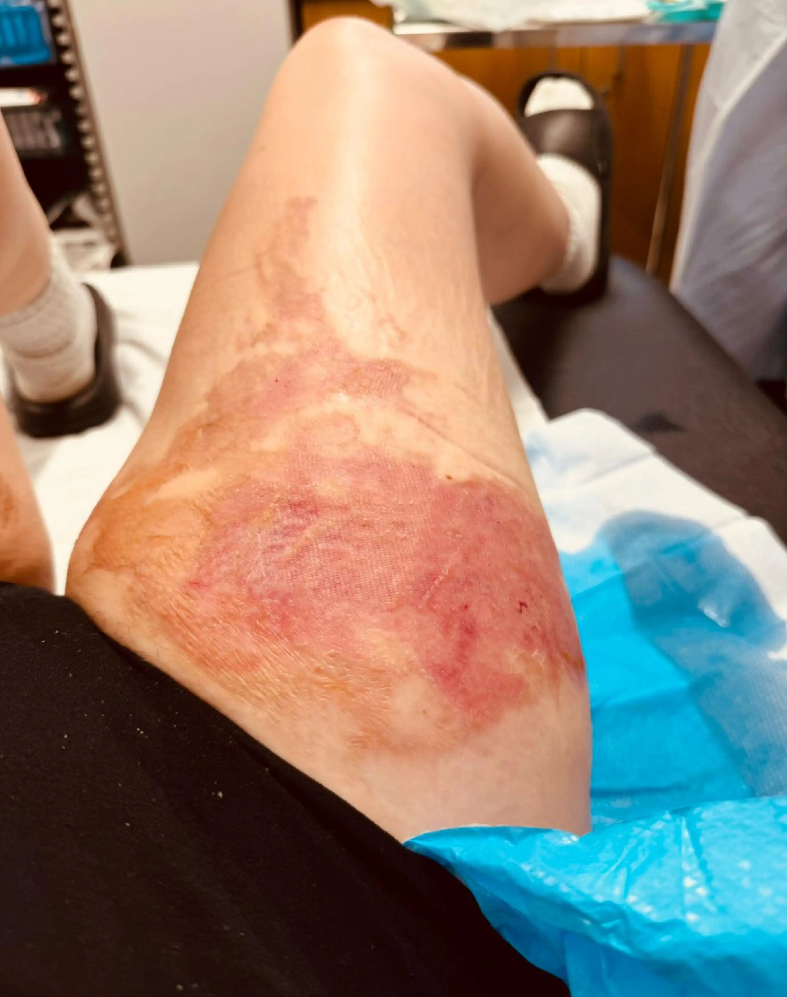 She suffered burns to her legs and lower stomach (Kennedy News and Media)