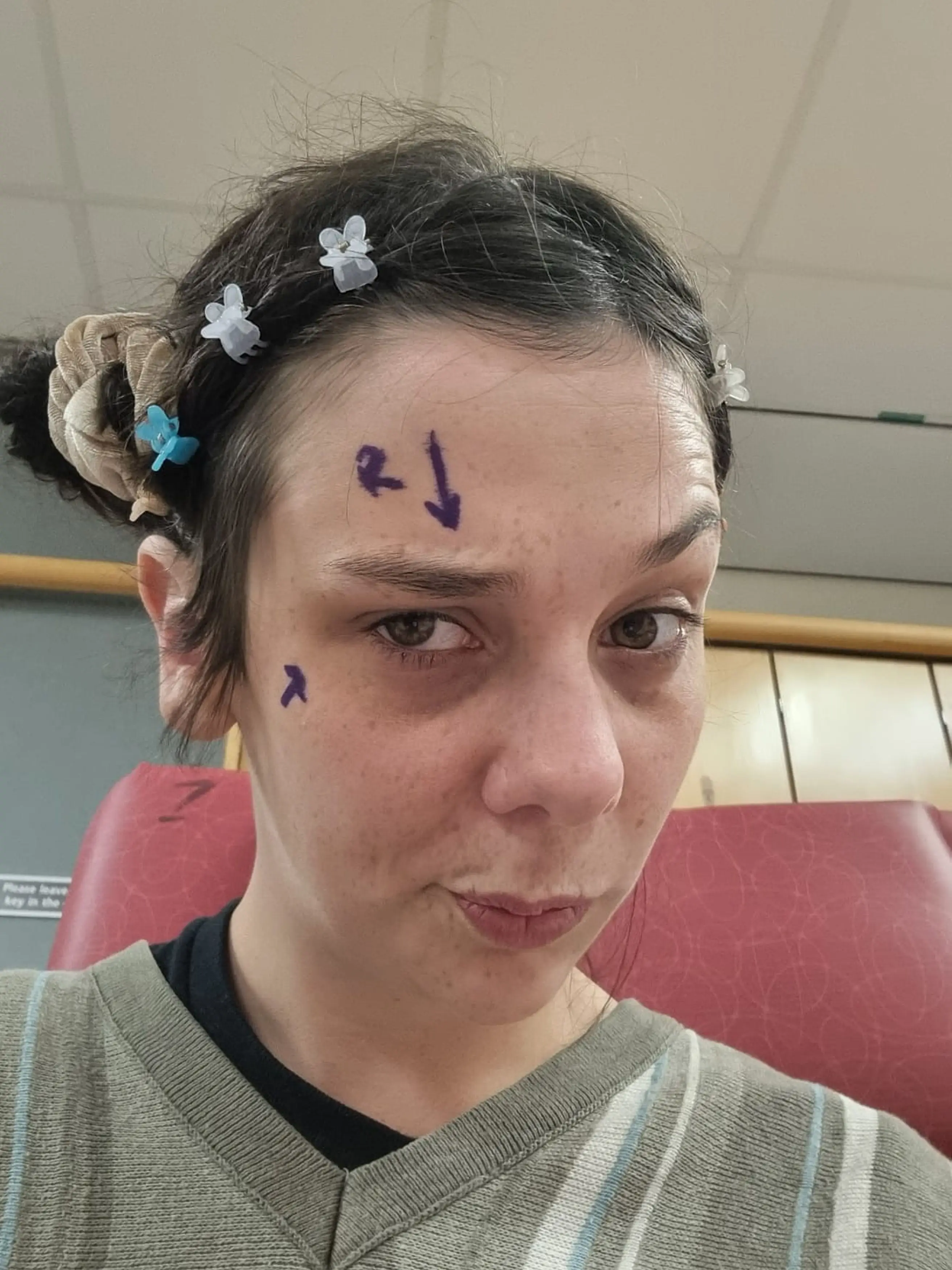 Jade had her right eye removed last month and is adjusting to its loss (Kennedy News and Media)