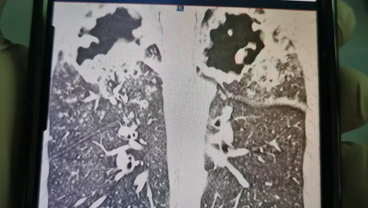 Chris Capper's lungs have been disintegrated by the disease (GoFundMe)