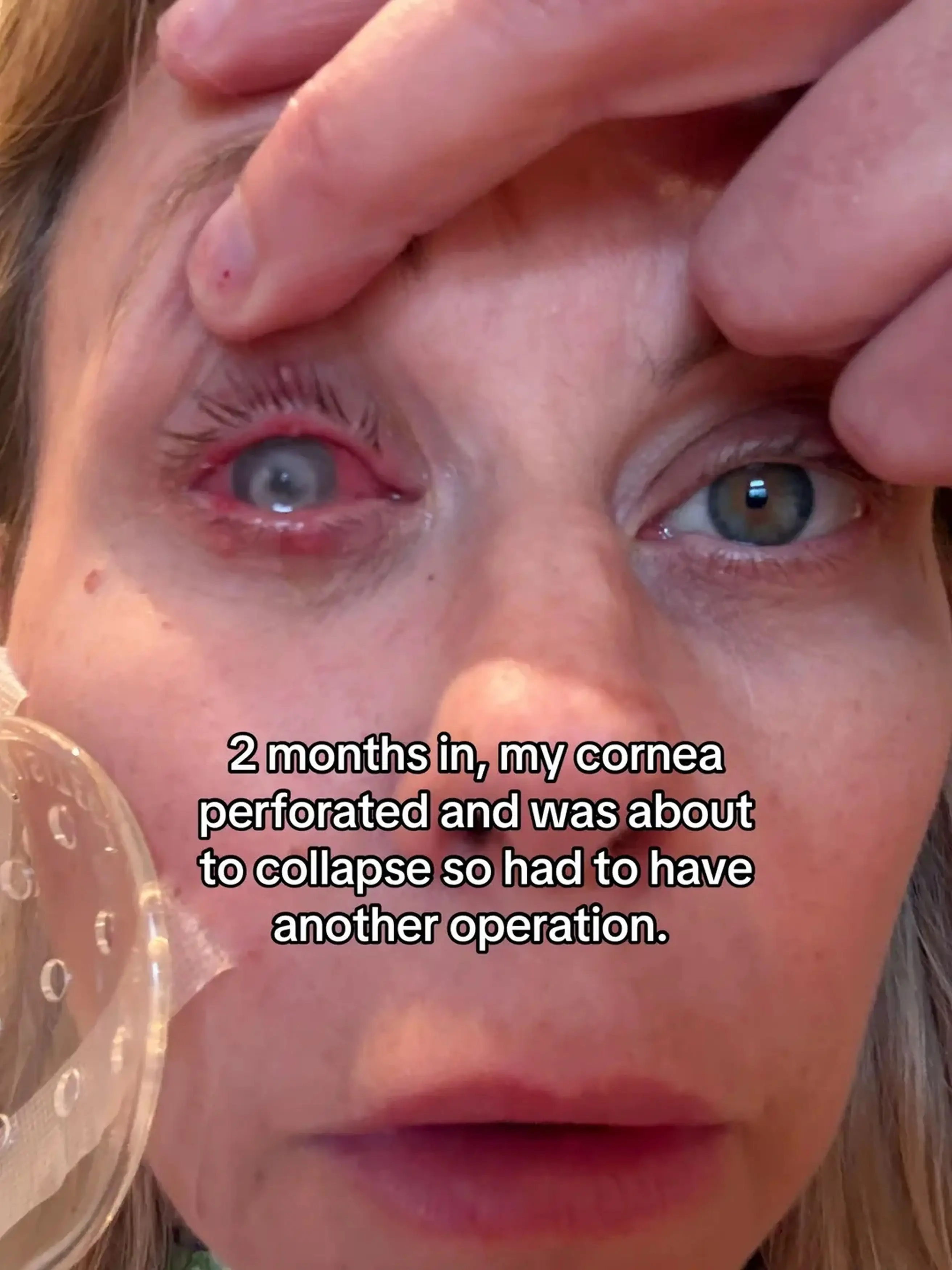 A few days later she started feeling a pain in her right eye, doctors initially said it was an ulcer but a week later she was told a parasite was eating her cornea (Kennedy News and Media)