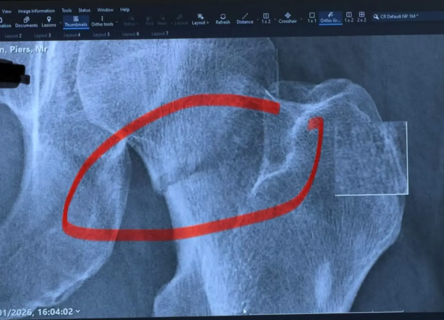 The journalist shared an X-ray of his femur (X/PiersMorgan)