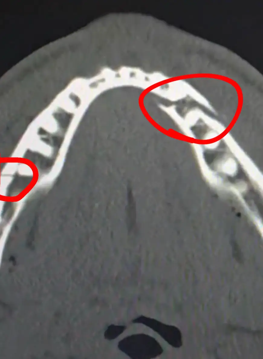 An X-ray appears to confirm a double break. (jakepaul/Instagram)