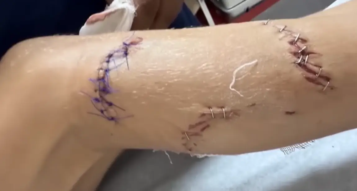 He needed 1,000 stitches (Good Morning America)