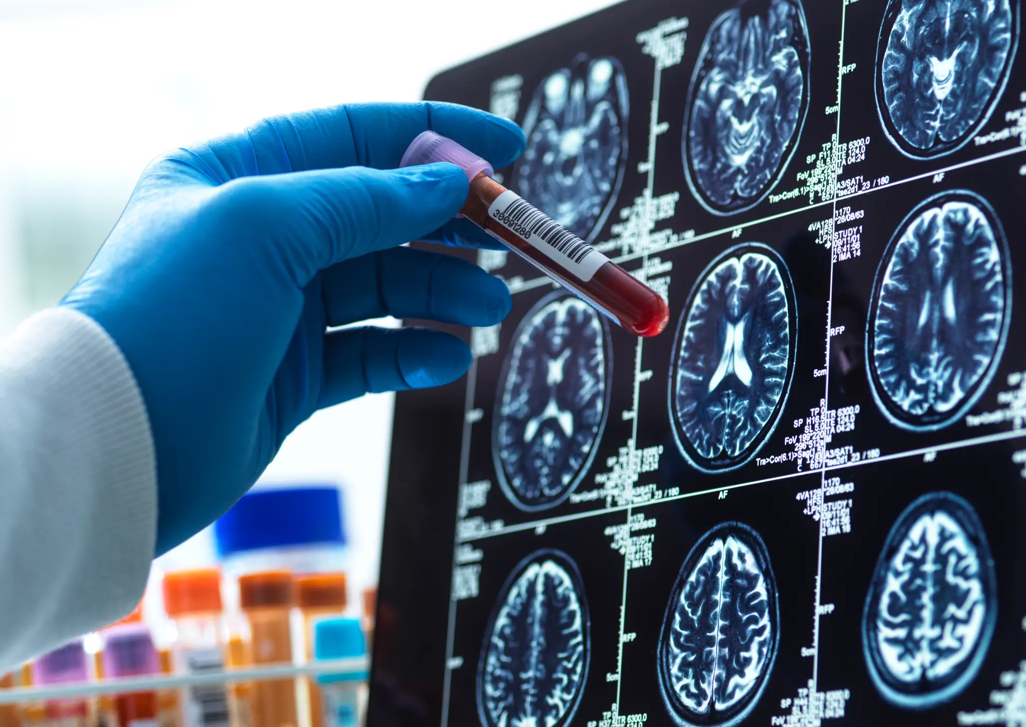 Scientists think they have made a breakthrough in Alzheimer's research (Getty Stock Image)