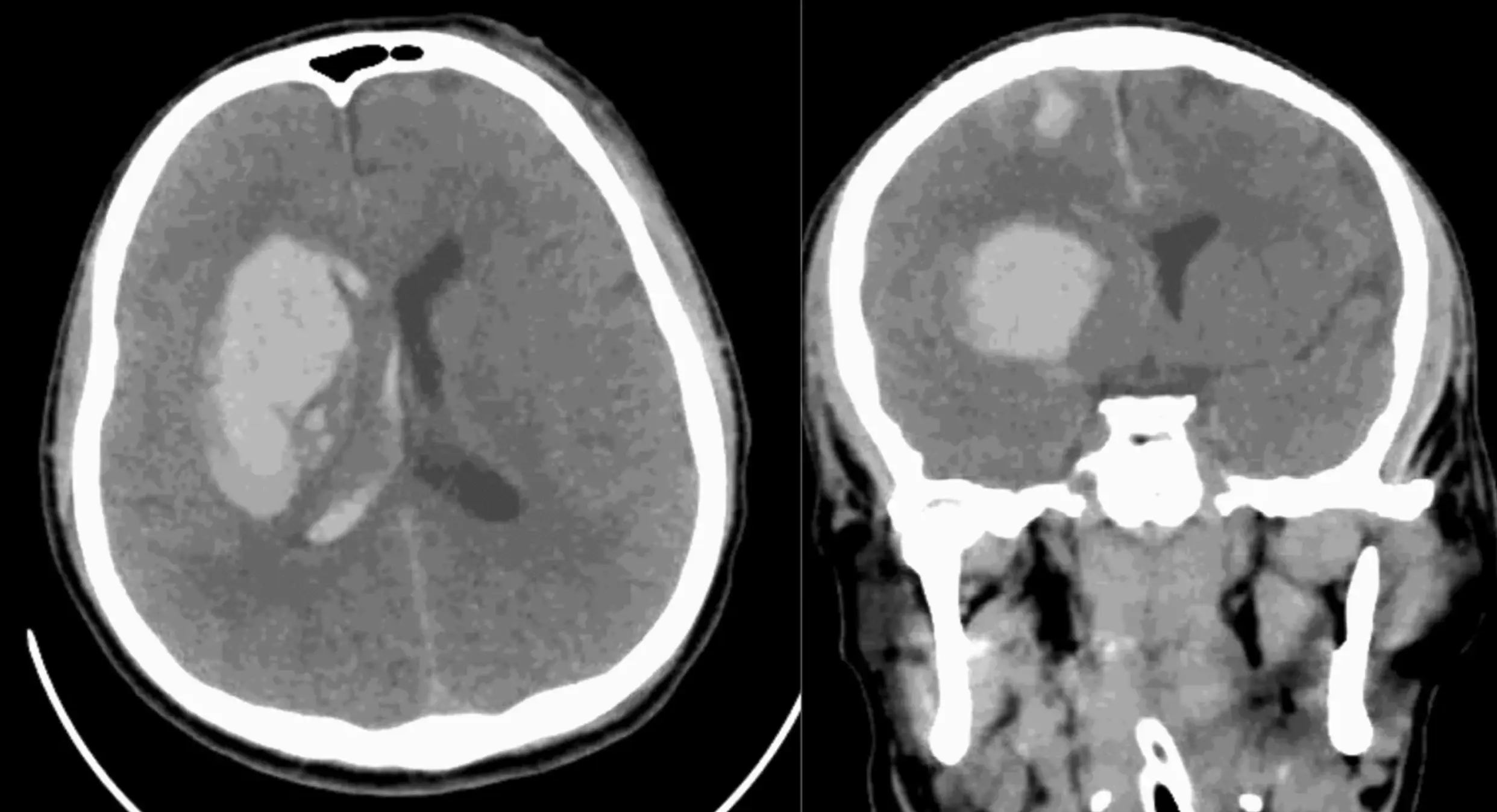 C. auris can infect the brain among other parts of the body (Journal of Medical Case Reports)