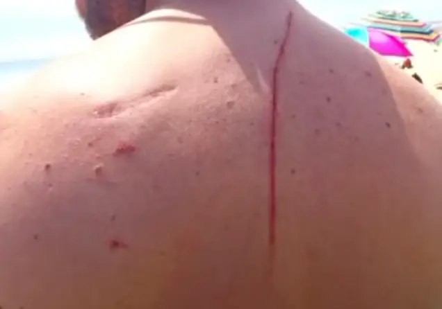 Finney experienced chest pains as a result of the injury.