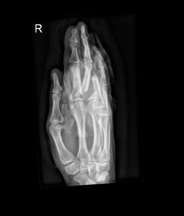 He lost two fingers in the work accident (SWNS)