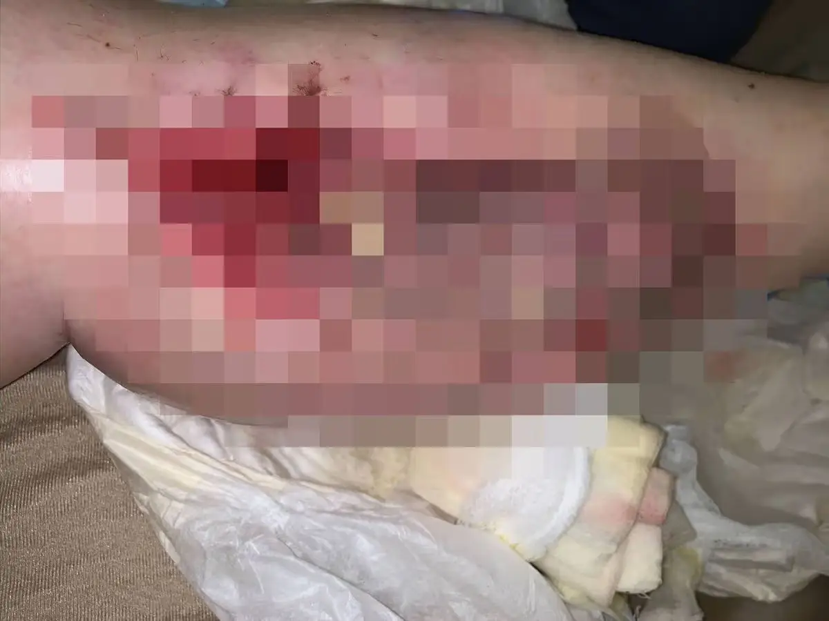 Results showed that Julia had compartment syndrome caused by lying in an awkward position which blocked the blood flow to her legs (Kennedy News and Media)