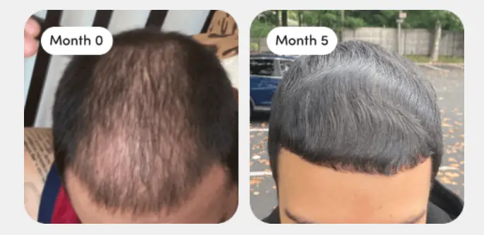 There's a huge range of hair loss treatments on offer (HIMS)