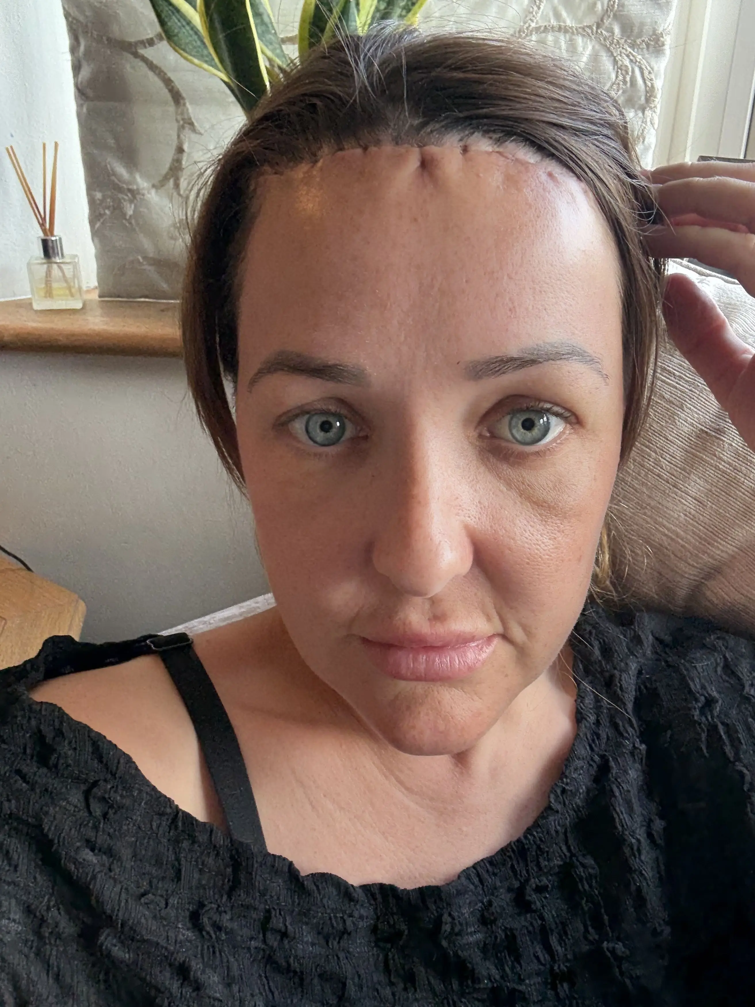 Chloe spent £5,000 on forehead reduction surgery (Kennedy News and Media)