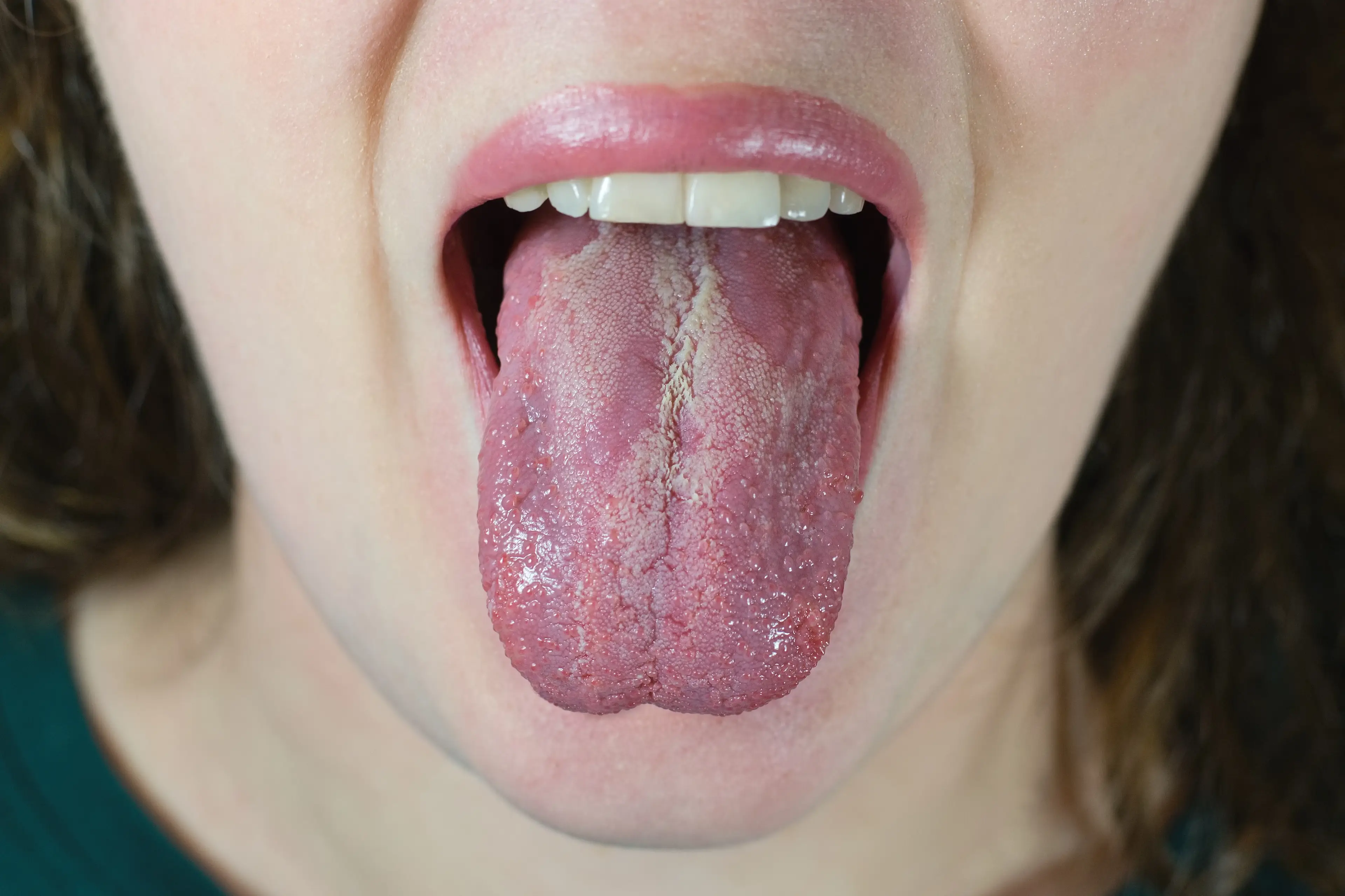 Common conditions like Oral Thrush will no longer be treated by the GP. (Tunatura / Getty Images)