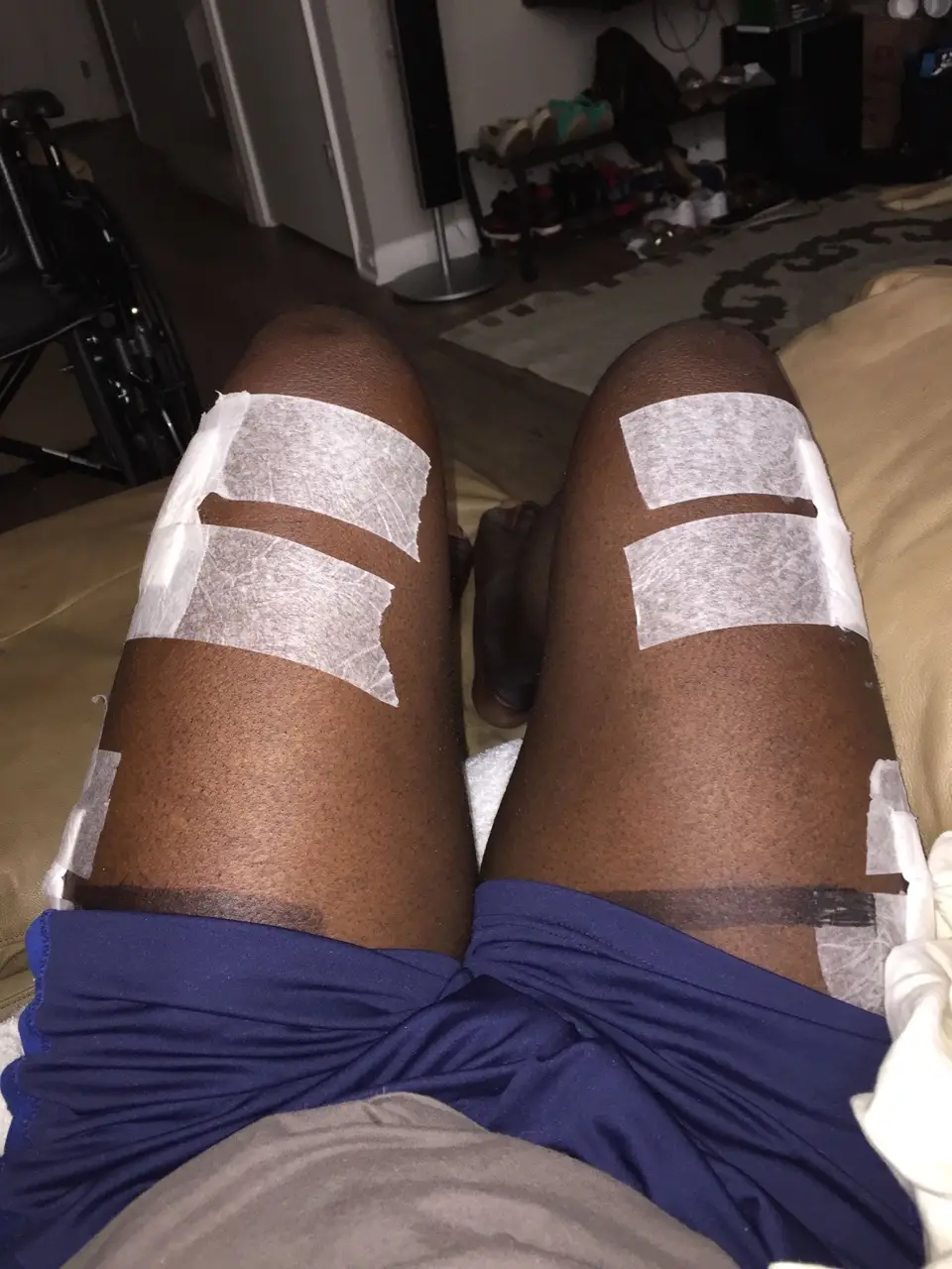 Moses had another surgery last month.