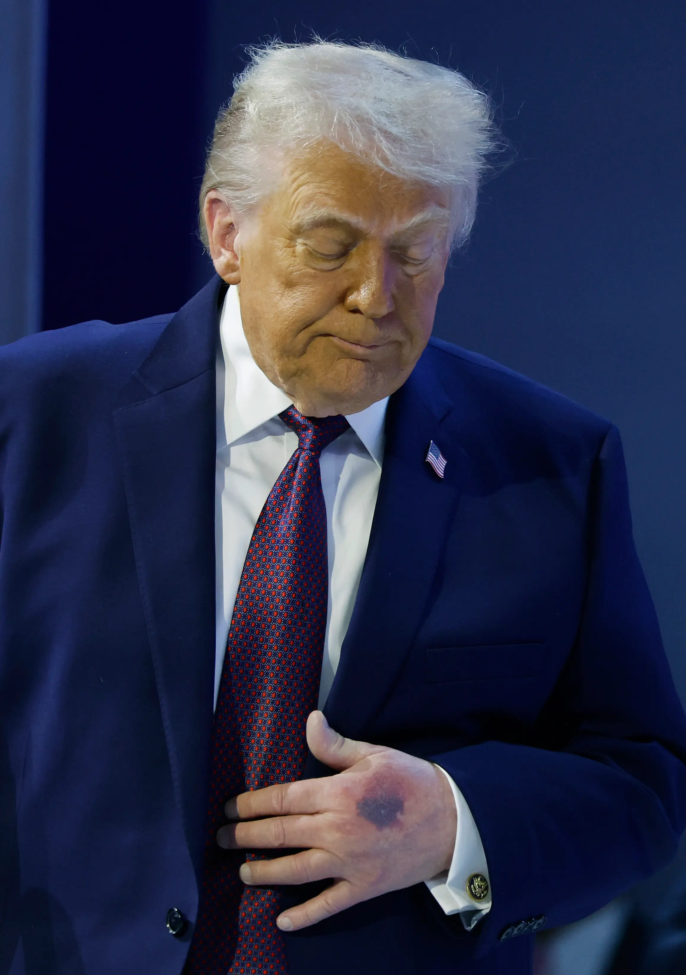 The bruises sparked speculation about Trump's health (Chip Somodevilla/Getty Images)