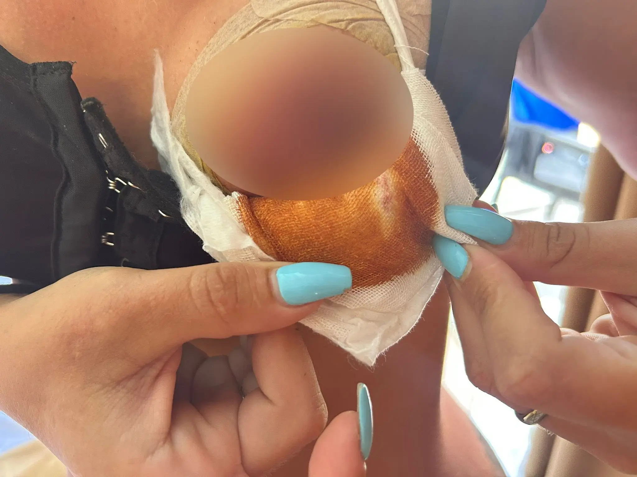 Necrosis occurs when cells and tissue die prematurely, due to insufficient amounts of blood reaching the area (SWNS)