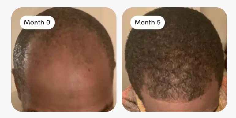 Some customers say they saw results in 'three months' (HIMS)