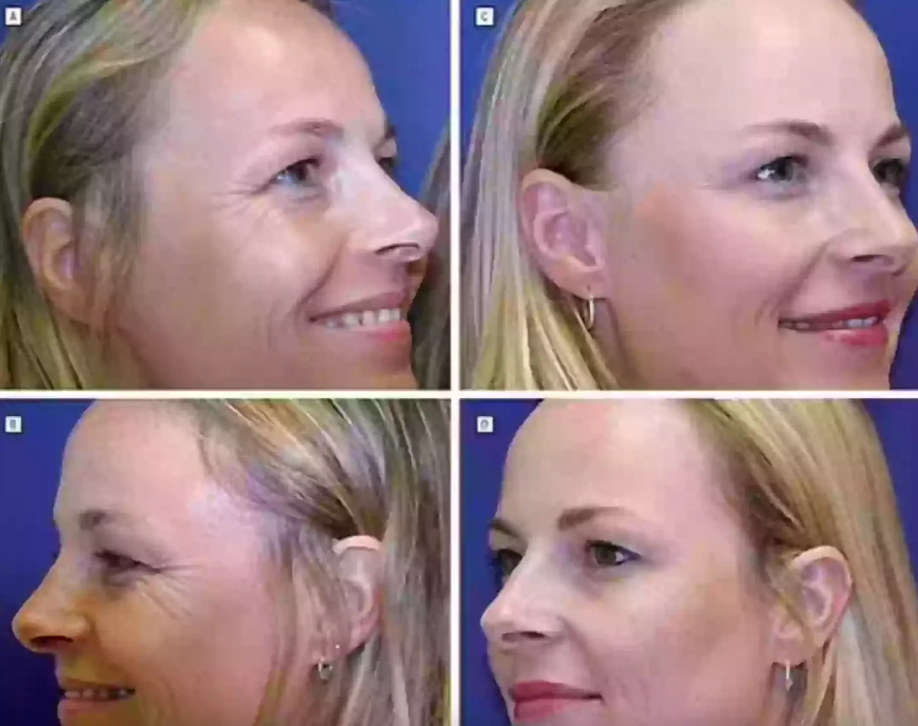 The twin on the right took regular injections of Botox (American Medical Association)