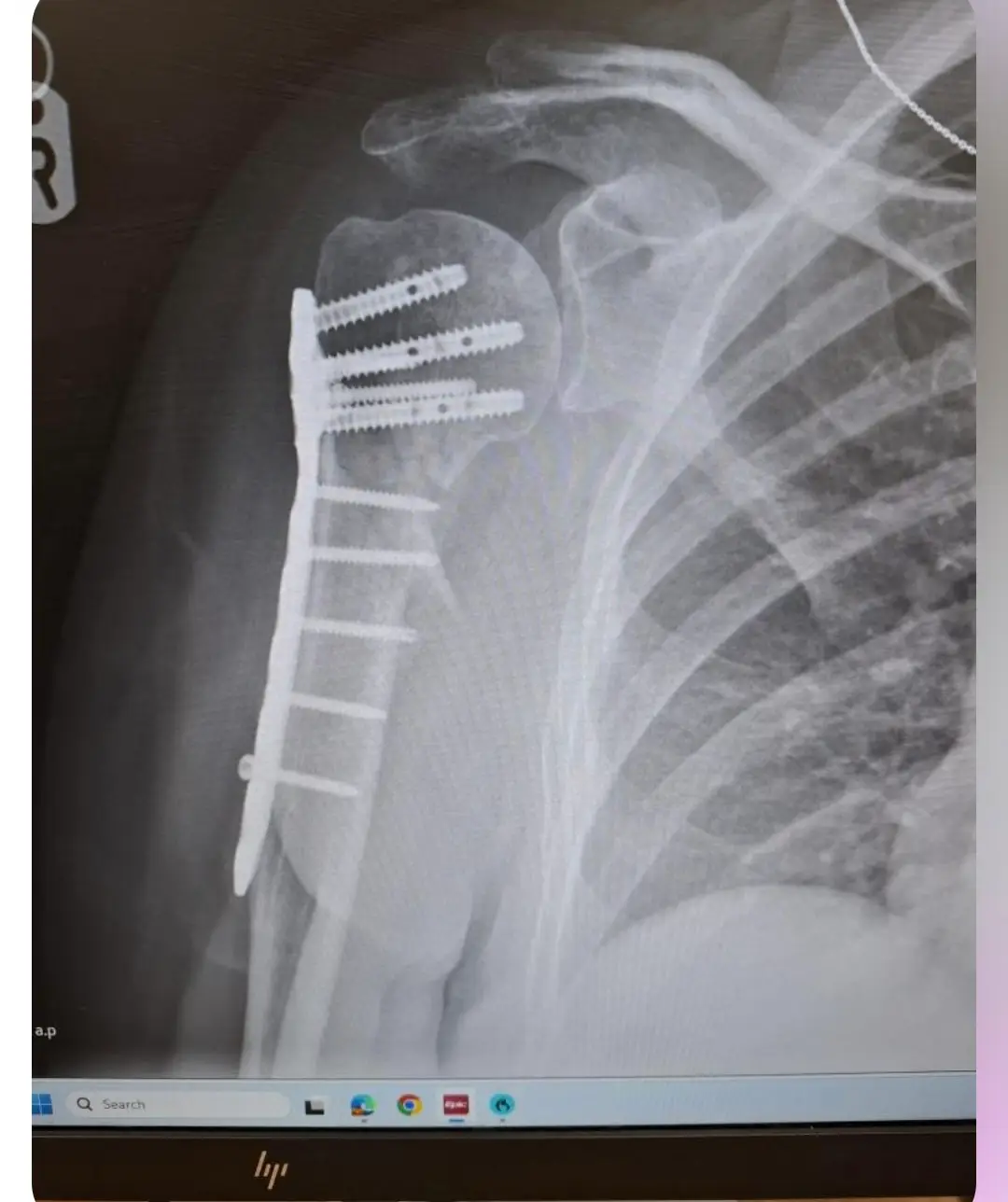 Jane had multiple fractures (MFT)