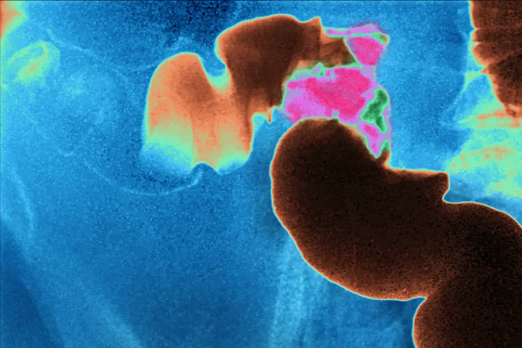 More young people are getting bowel cancer (CAVALLINI JAMES/BSIP/Universal Images Group via Getty Images)