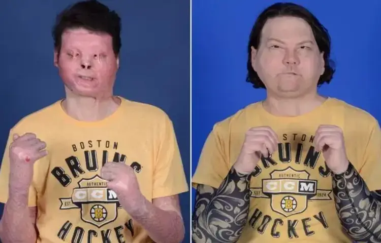 The face and hands transplant in 2020 changed things significantly for Joe (NYU Langone Health)
