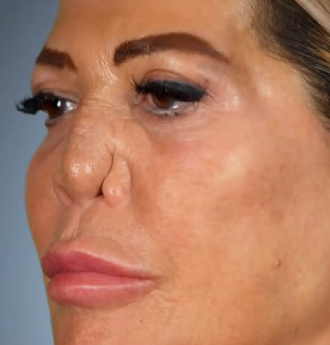 Demi before her reconstructive surgery (E! Entertainment via YouTube)