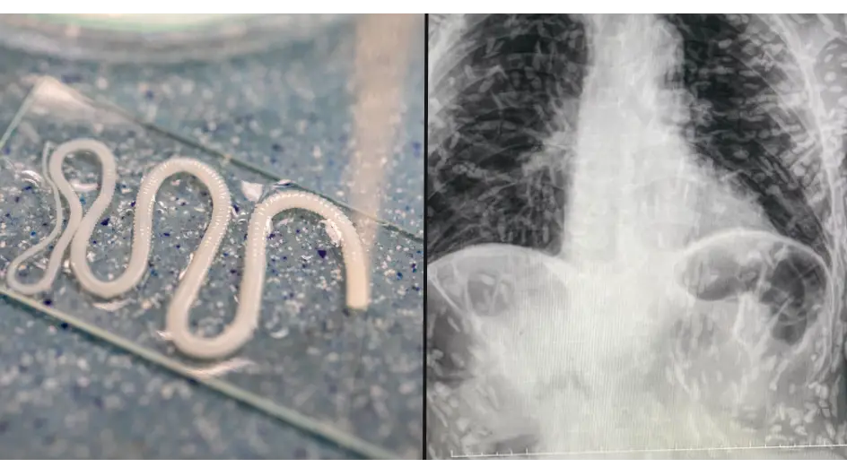 Man who went to hospital with cough shocked to discover he’s swarming with tapeworms
