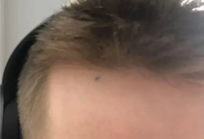 It's not just the hands where people have marks.