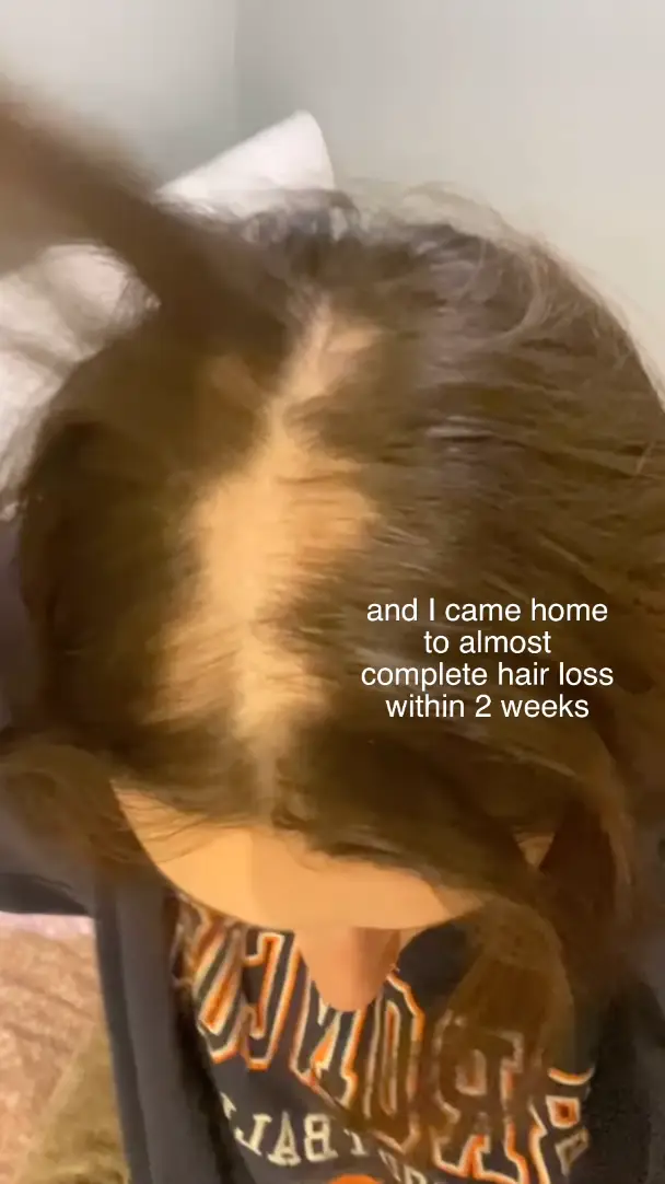 Lozzy explained she has been diagnosed with alopecia (Instagram/@loz.jo.x)