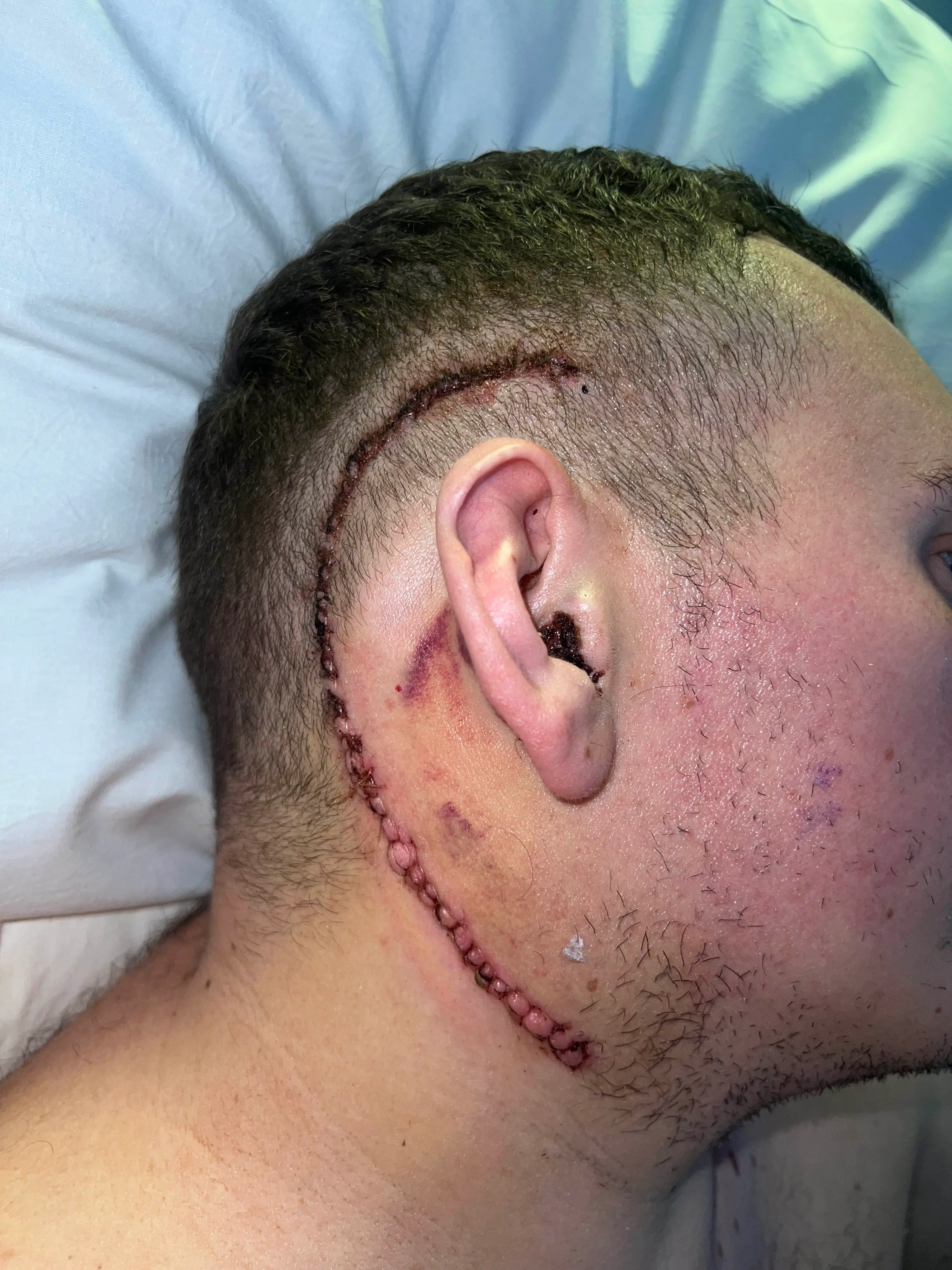 Jake's gruesome head wound (SWNS)