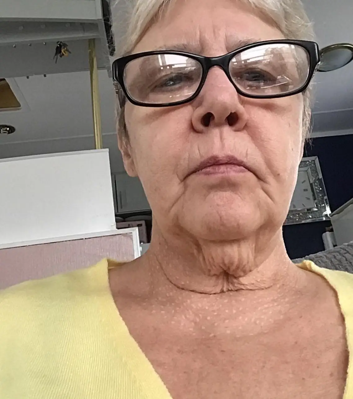 Jane's neck some time on after getting the procedure.