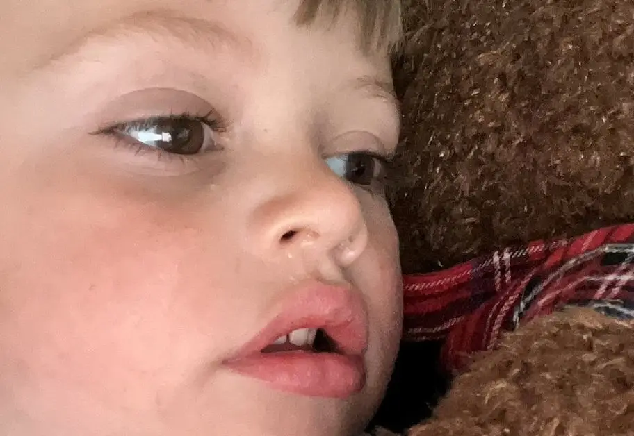 The white glow in Isaac's right eye (SWNS)