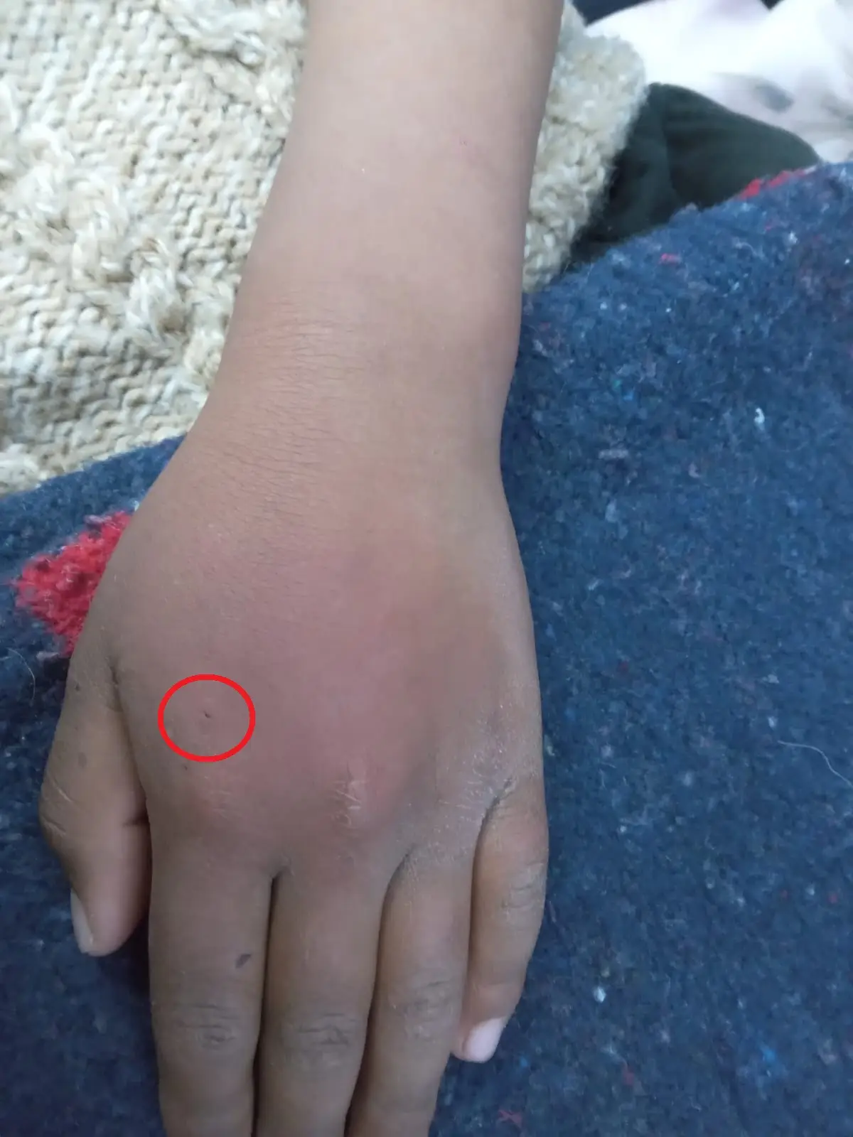 The youngster provoked the spider until it bit him.