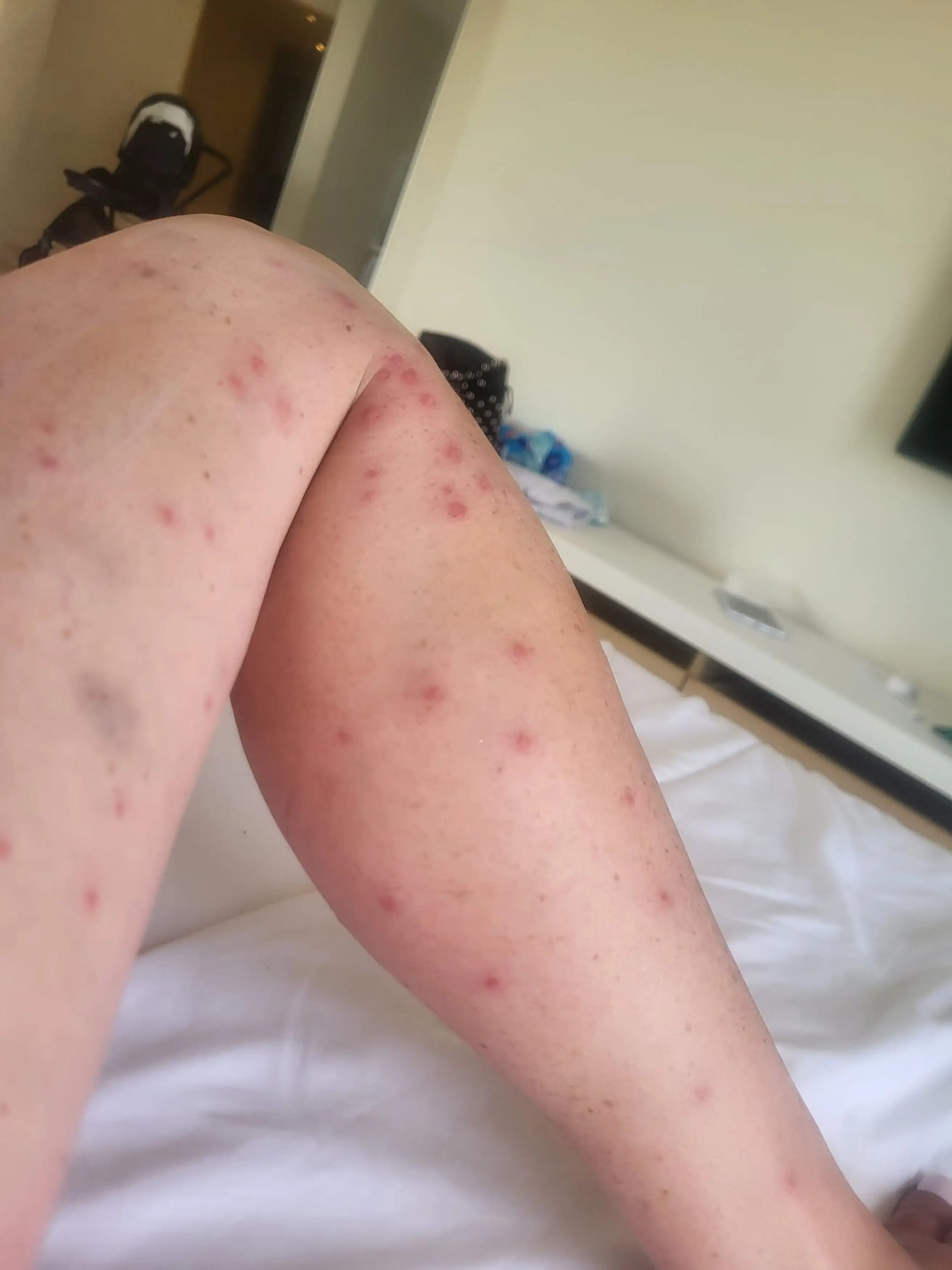 Emma got a prescription for the mosquito bites, but she fainted and fell down a flight of hotel stairs (Kennedy News and Media)