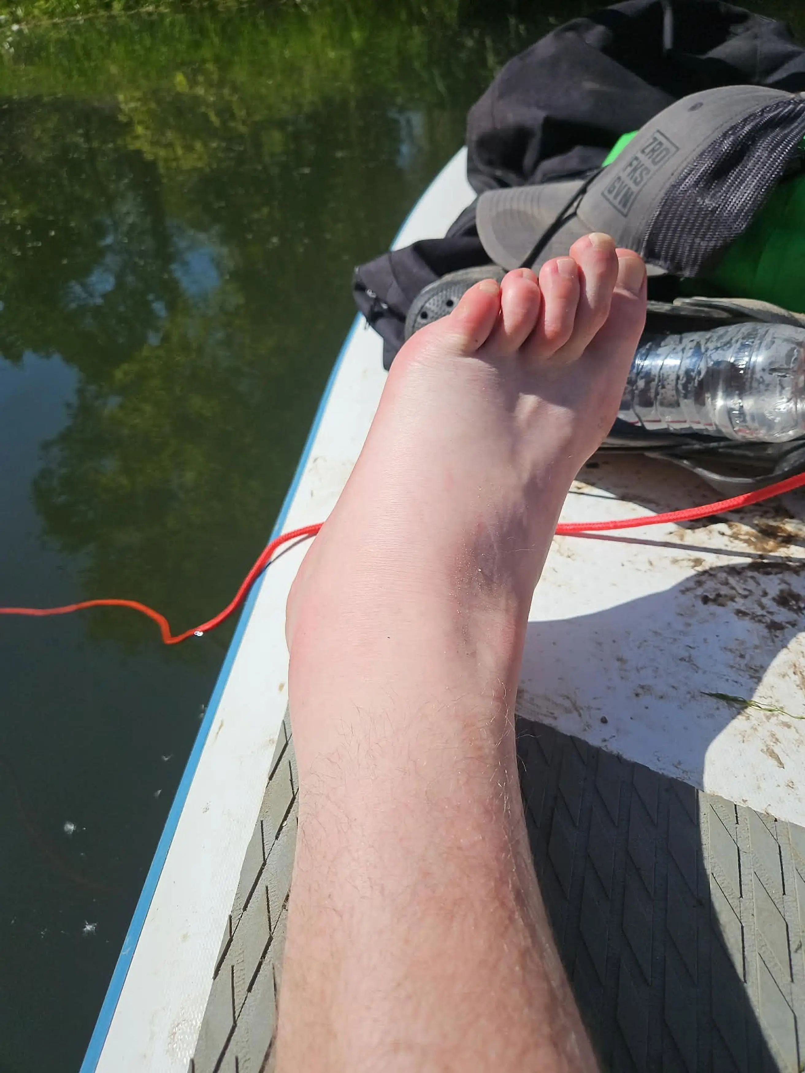 Zak was bitten while paddleboarding (Kennedy Media)