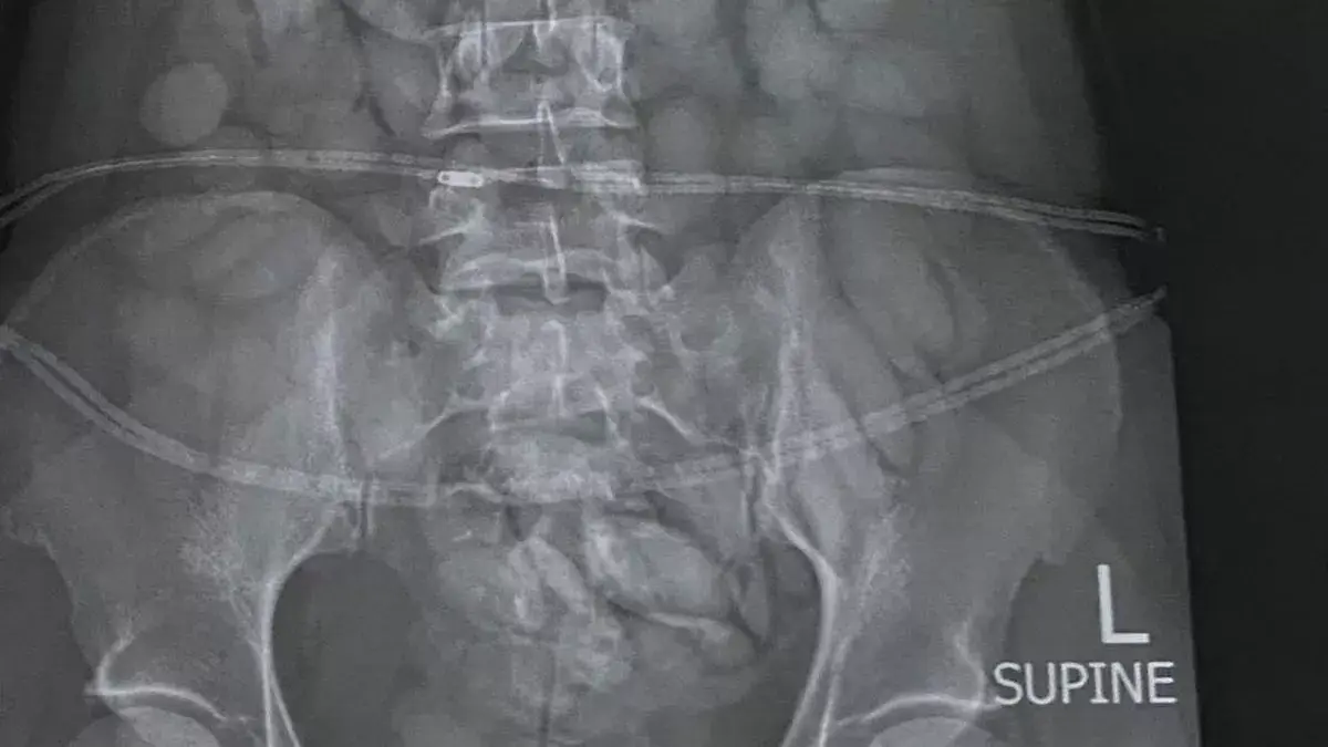 The X-ray showed she'd likely swallowed them all. (SA Police Services)